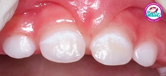 dientes-marrones-01