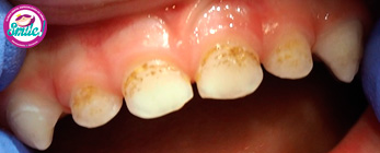 dientes-marrones-02