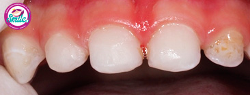 dientes-marrones-03