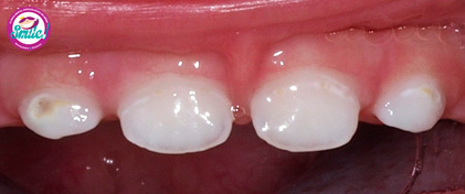 dientes-marrones-04