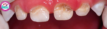 dientes-marrones-05