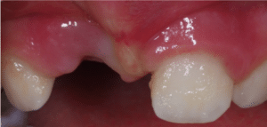 Avulsion dental en un niño