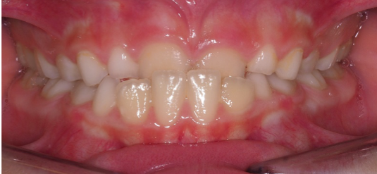 Paciente de 9 años, antes de 6 meses en tratamiento Ortodoncia Invisible