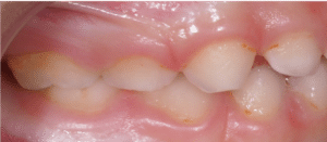 Manchas en los dientes por mal cepillado